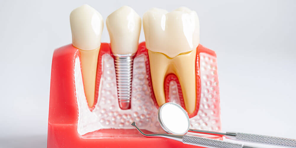 Implants dentaires Dorval