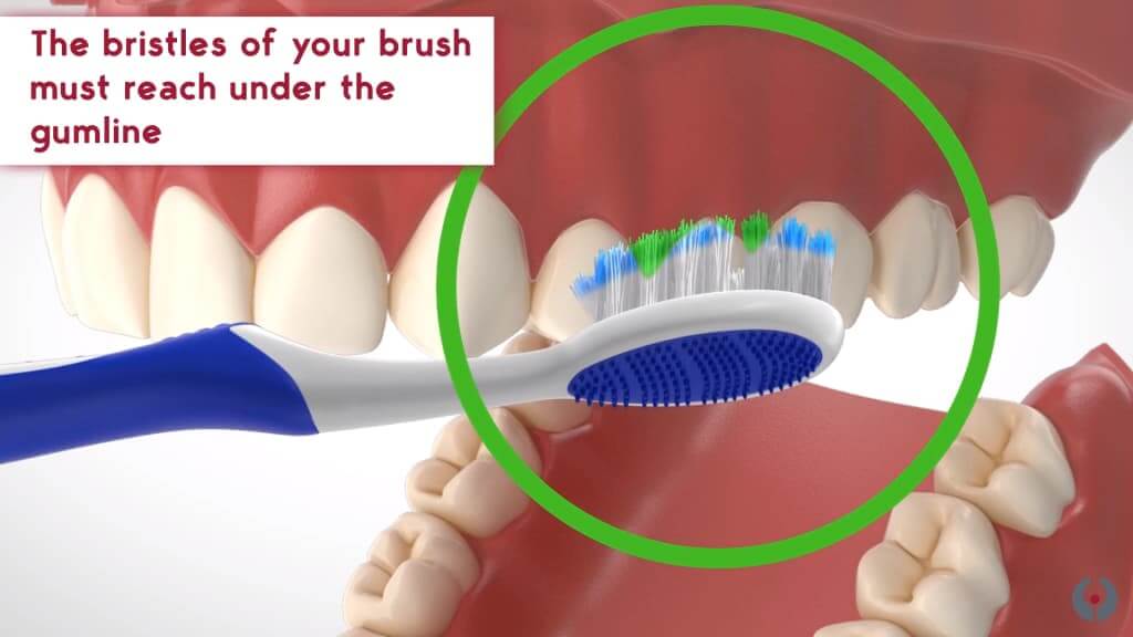 Technique de brossage sulculaire